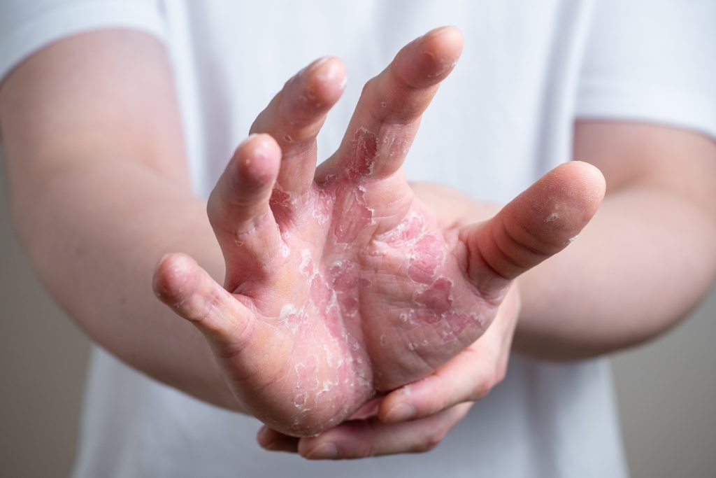 close up su mano affetta da Dermatite Atopica