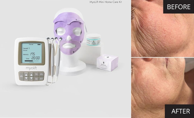 RISULTATI PRIMA E DOPO CON dispositivo di microcorrente MYOLIFT MINI