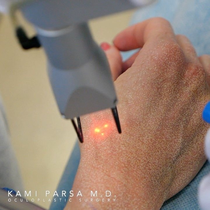 pRIMO PIANO di trattamento estetico laser c02 su una mano 