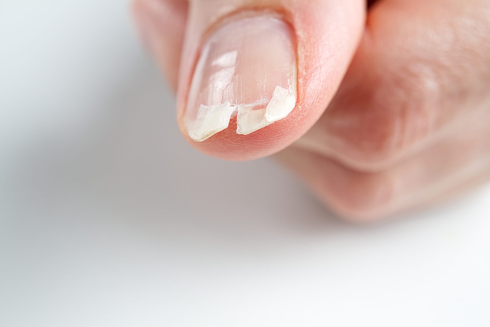 Unghia rotta su una mano femminile. Primo piano dell'unghia rotta. Concetto di mani e carenze nutrizionali e di unghie e carenze nutrizionali