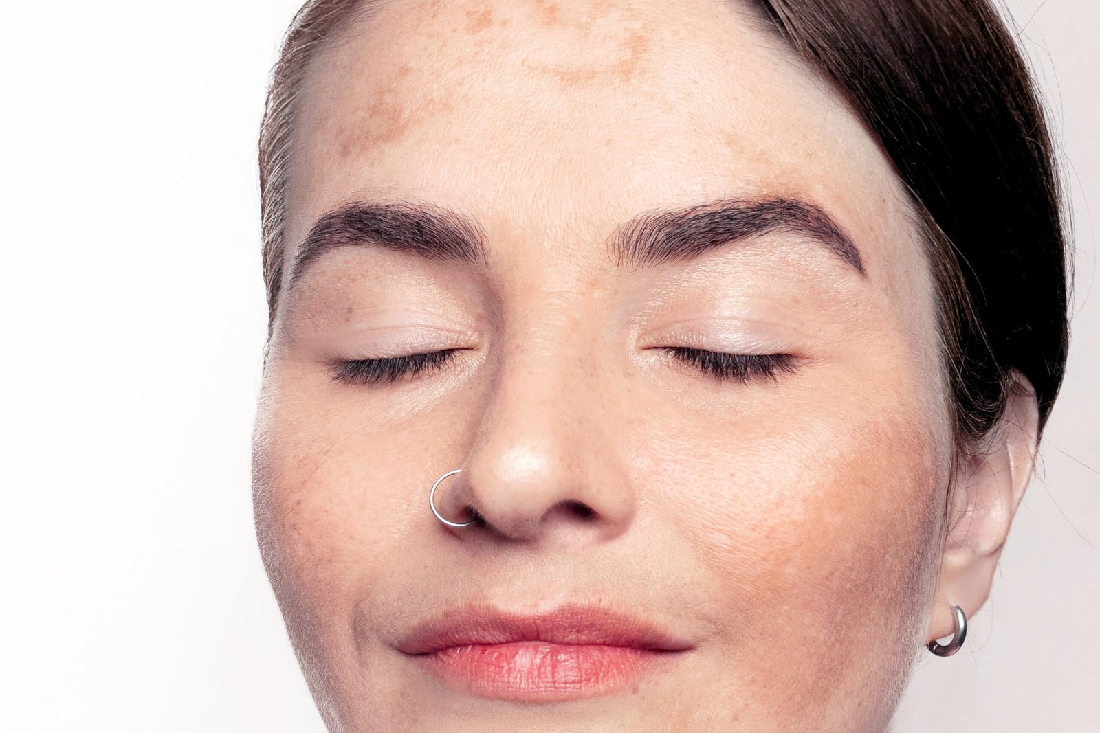 concetto routine skincare mare : ragazza primo piano con melasma e iperpigmetazioni